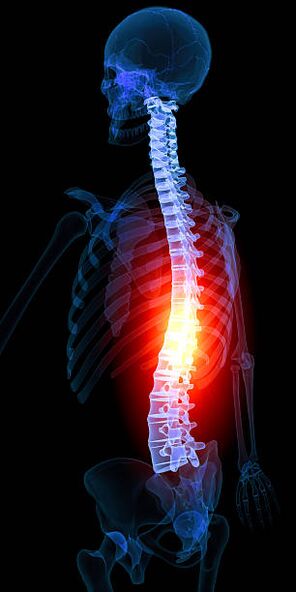 thoracic spine osteochondrosis